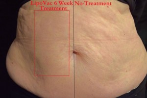 LipoVac Before & After